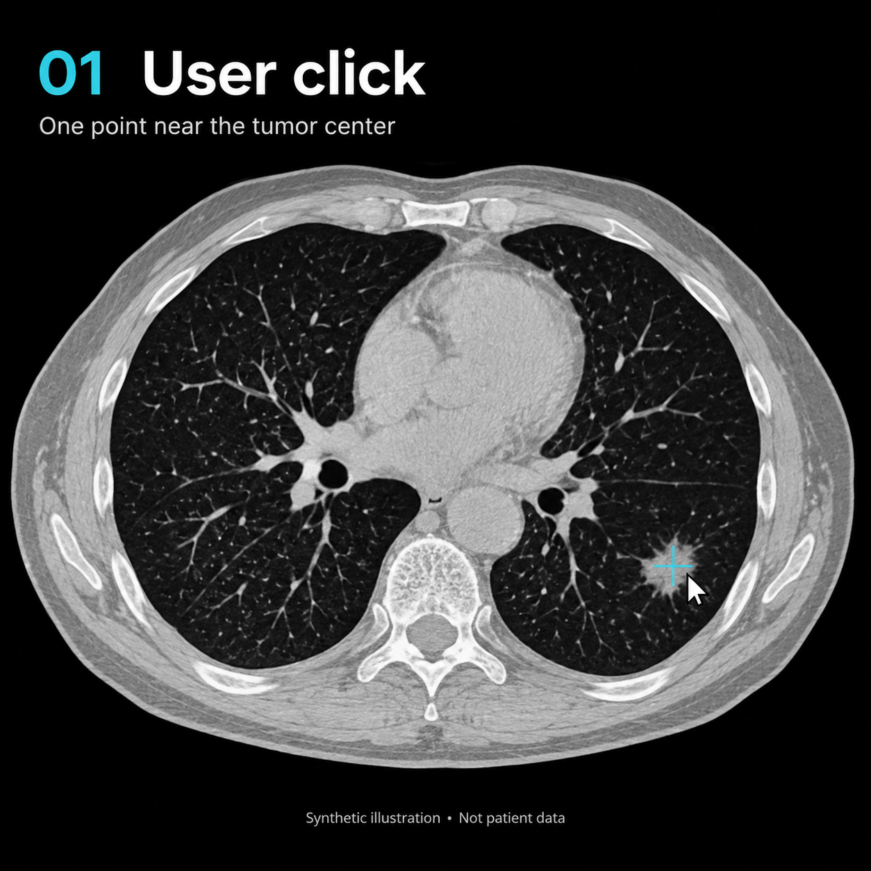 Step 1: User click — a single point marked near the tumor center on the CT slice.
